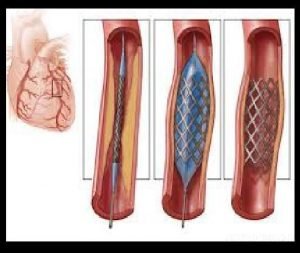 cardiac stent micro capillary